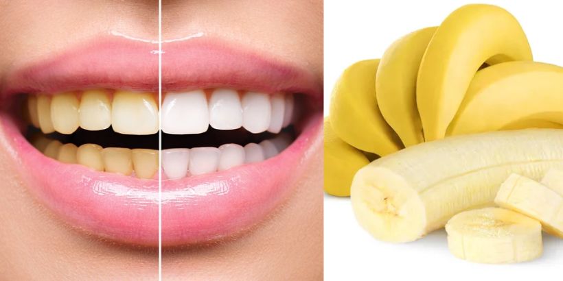 yellowness of teeth