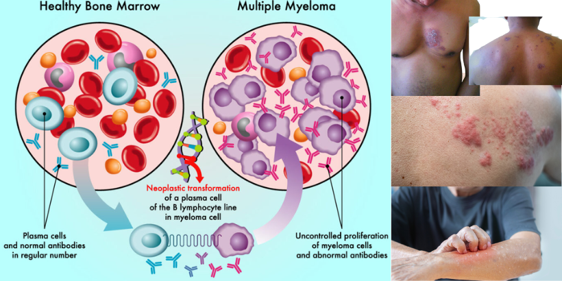 Is Multiple Myeloma disease really dangerous? Know what is its treatment